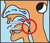 Schematische Darstellung des Schnarchens. Durch das Zurückfallen des Unterkiefers werden die oberen Atemwege verlegt. Es entsteht Schnarchen und Schlafapnoe.